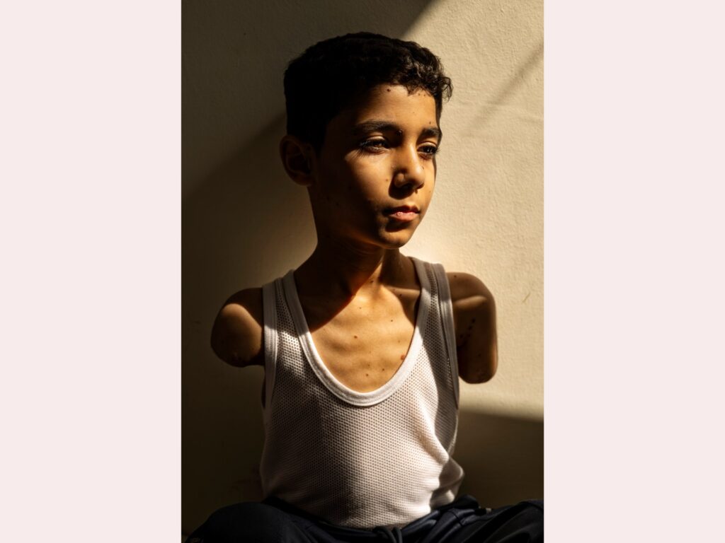 Portrait of amputee Palestinian boy from Gaza wins World Press Photo award | Israel-Palestine battle News | USAEMALL.com
