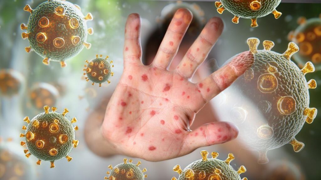 Department of Health unveil two new measles exposures websites within the South West | USAEMALL.com