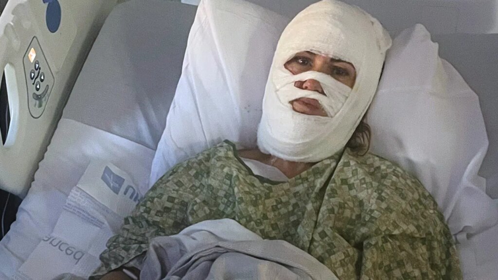 Chemical assault leaves Georgia girl hospitalized with third-degree burns | USAEMALL.com