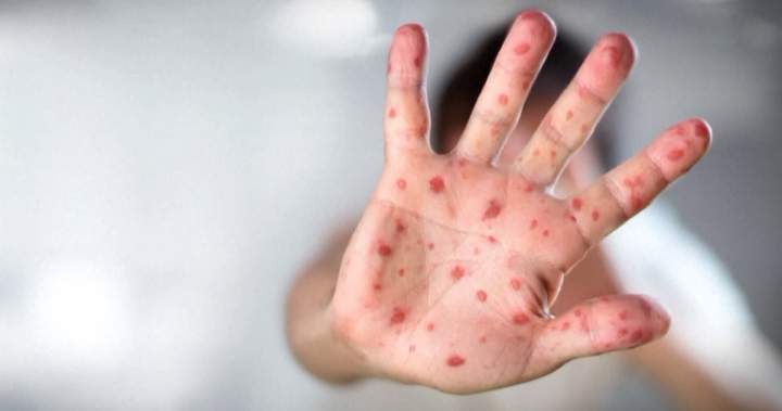 Manitoba sees 44 measles instances in first week of February – Winnipeg | USAEMALL.com
